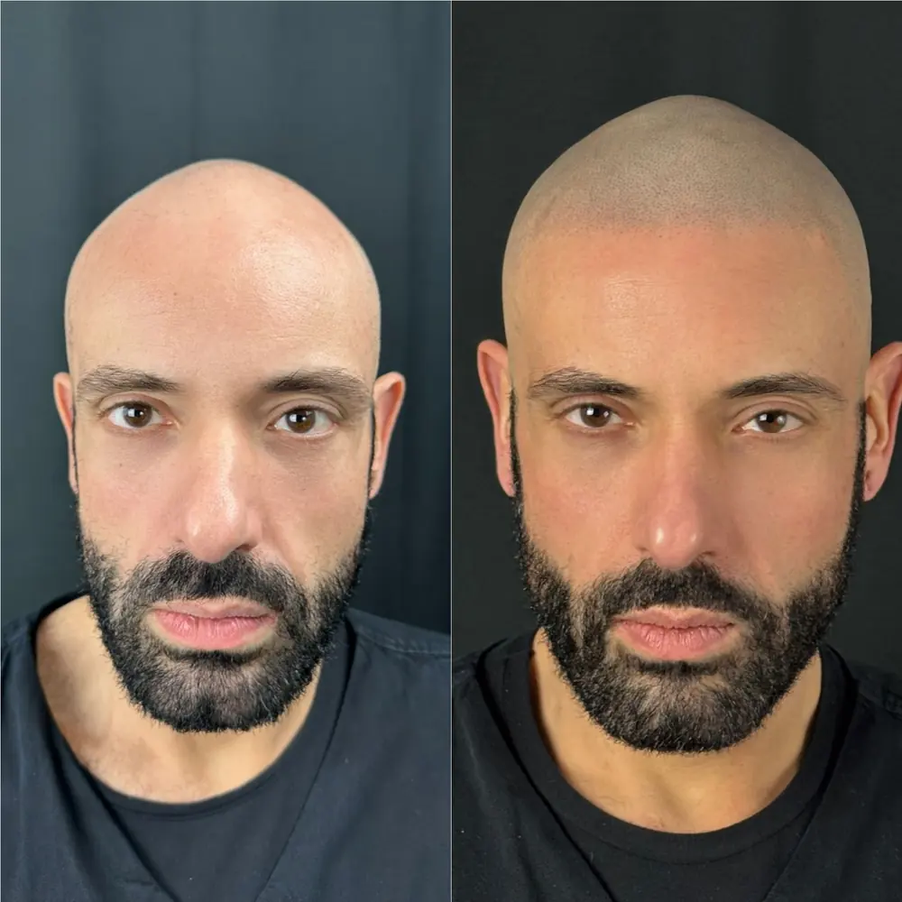Tricopigmentazione effetto rasato, prima e dopo: vista frontale
